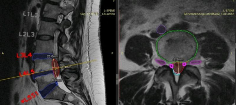 CoLumbo AI Spine