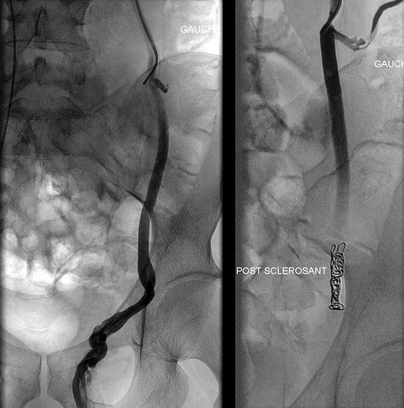 Embolisation-Varicocele-Lyon-Villeurbanne