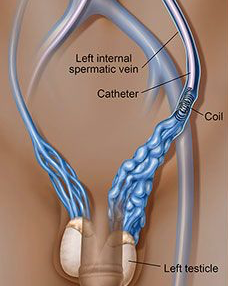 Embolisation de Varices Pelviennes et  Varicocèles