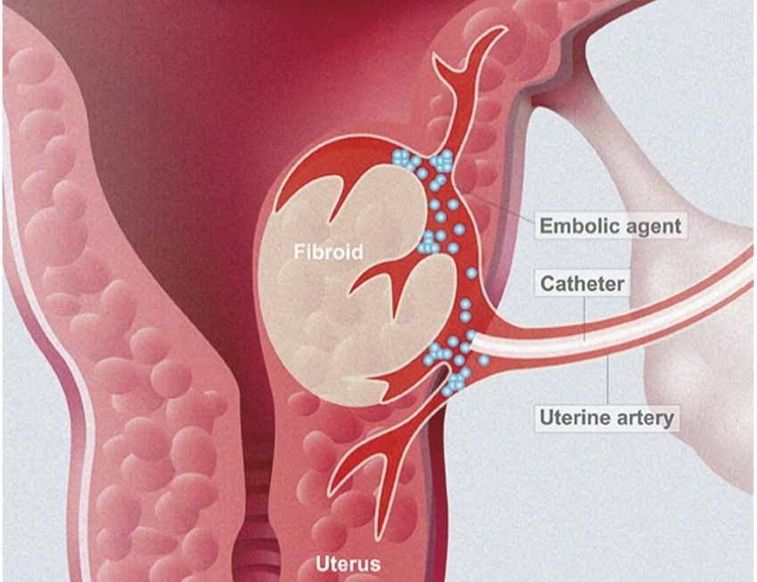 Embolisation de Fibromes Utérins