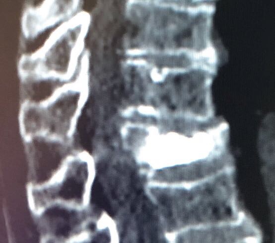 Cimentoplastie / Vertebroplastie