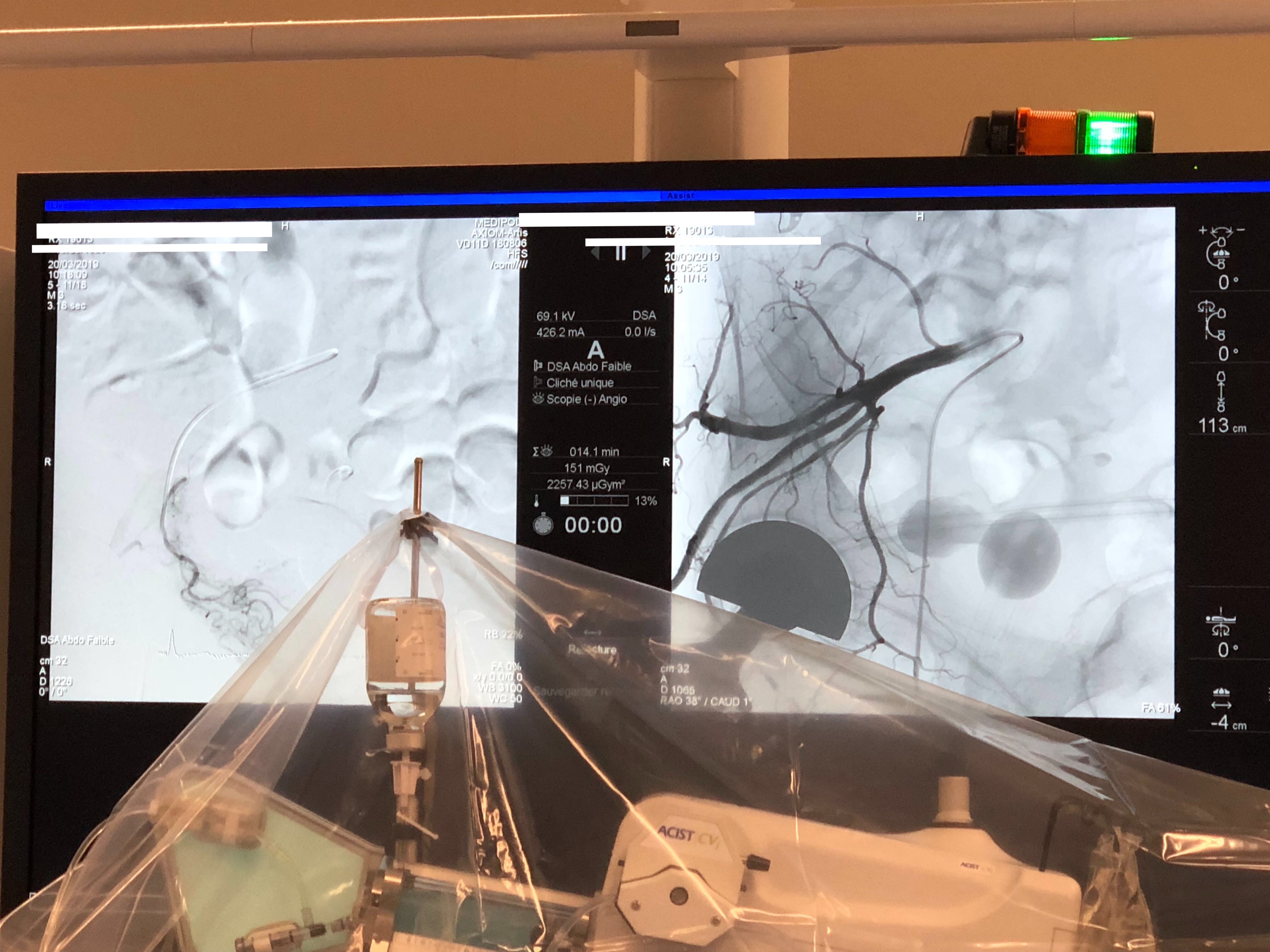 Embolisation de Prostate