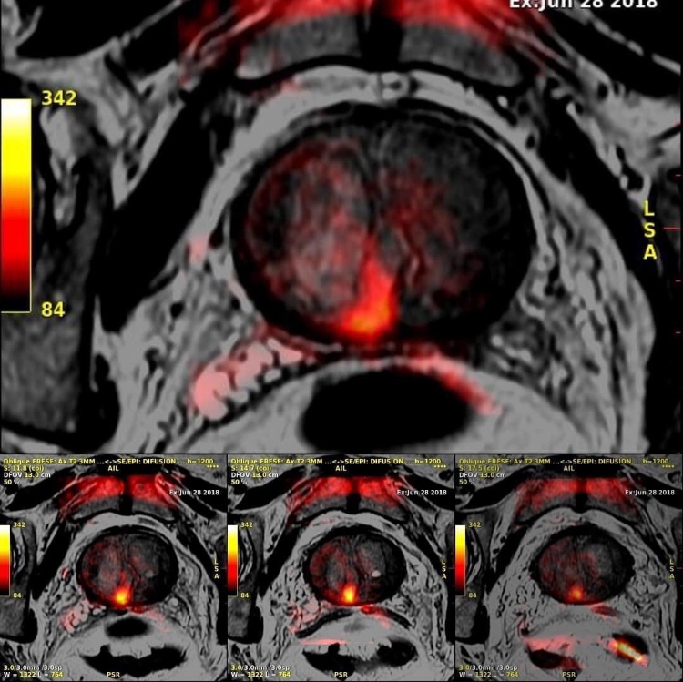 Imagerie IRM Multi-Paramétrique de la Prostate